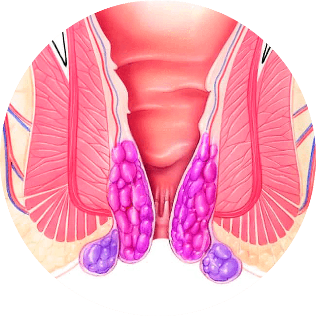 Το Gelarex ανακουφίζει από τα συμπτώματα από την πρώτη εφαρμογή